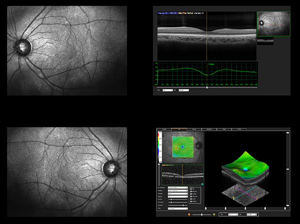 Optical Coherence Tomography Northwest Hills Eye Care