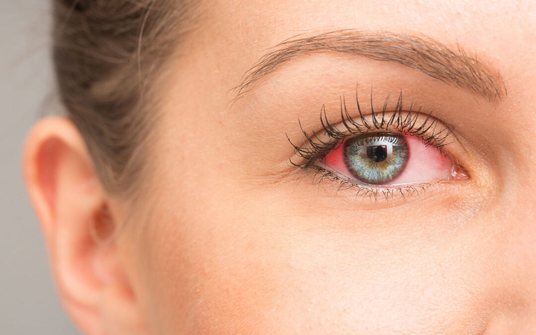 What is Conjunctivitis?