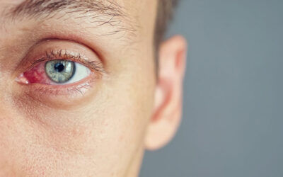 Why is Conjunctivitis So Contagious?